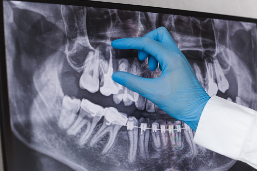 cirugia bucal | clinica dental mataro