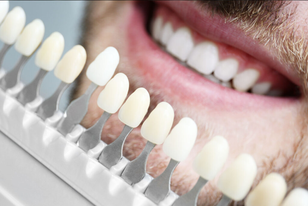 estetica dental | clinica dental mataro