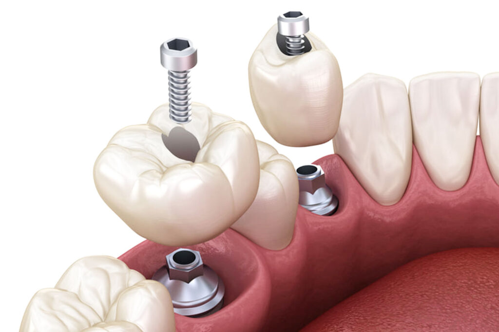 implantologia corona sobre implante atornillada | clinica dental mataro