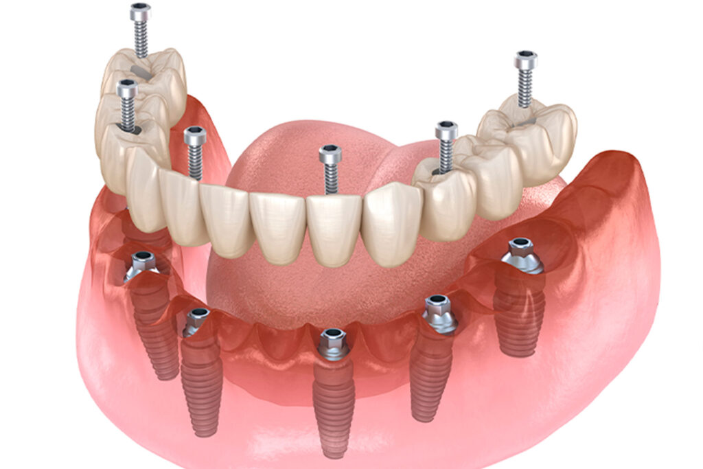 implantologia hibrida sobre 6 implantes | clinica dental mataro