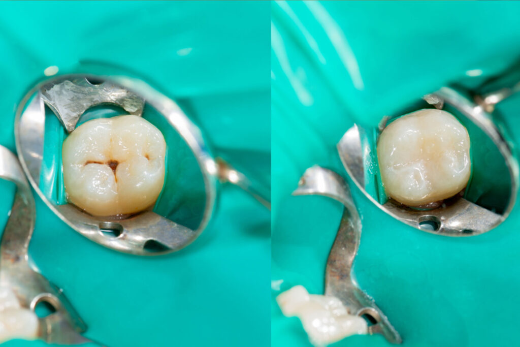 odontologia conservadora | clinica dental a mataro