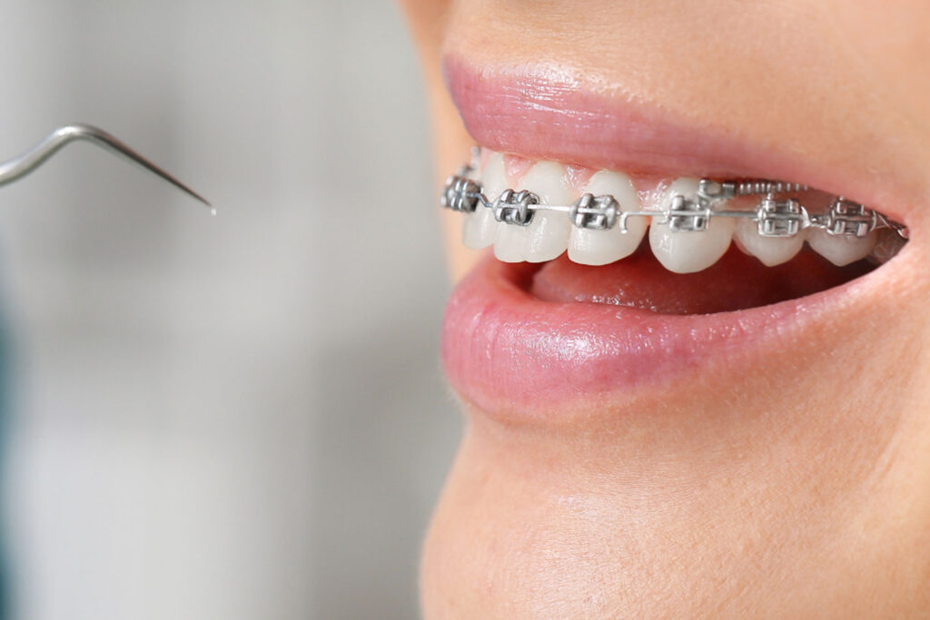 ortodoncia convencional brakets | clinica dental mataro
