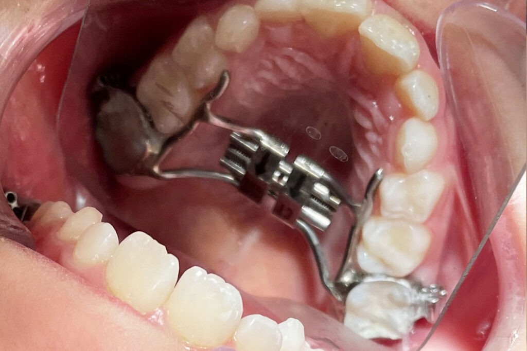 Ortodoncia interceptiva en edades tempranas para prevenir problemas orales en adultos.