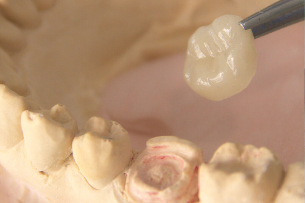 protesis | clinica dental a mataro