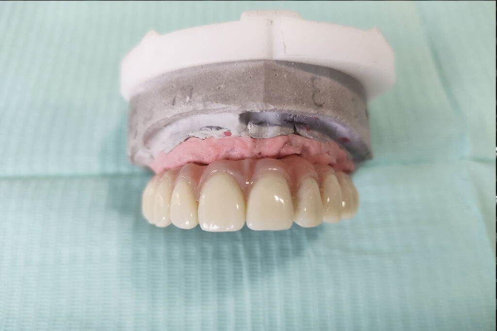 protesis arcada hibrida ceramica sobre implantes | clinica dental a mataro