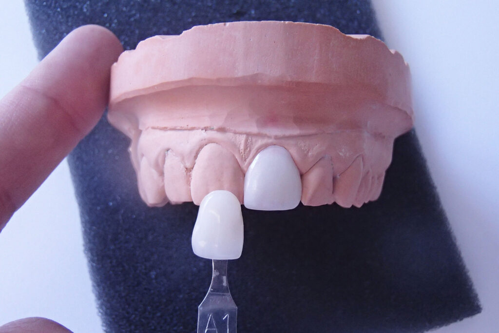 protesis carilla ceramica disilicato litio | clinica dental mataro