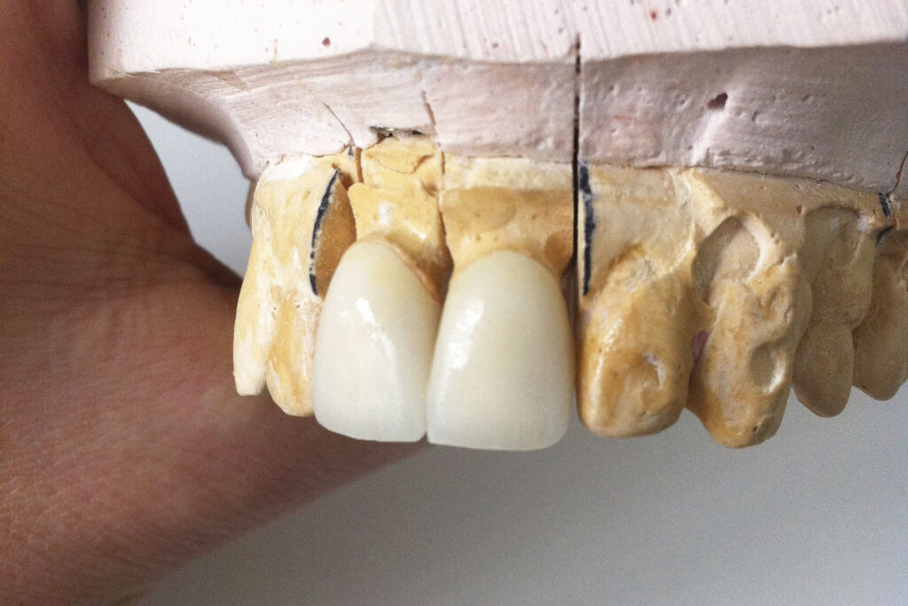 protesis corona zironi | clinica dental mataro