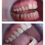 1-carilla-ceramica