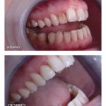 1-carilla-ceramica-ca
