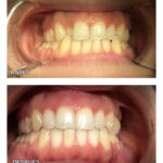 12-ortodoncia-invisible