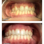 12-ortodoncia-invisible-ca