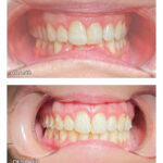13.1-ortodoncia-brakets-ca