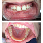 14.2-ortodoncia-precoc