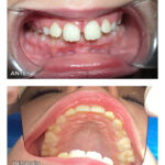 14.3-ortodoncia-precoc