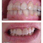 2-carilla-ceramica-ca