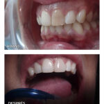 3-carilla-ceramica-ca