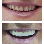 6.2-corones-fixes-bruxista-ca