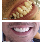 7.1-coronas-zirconio