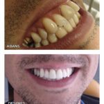 7.1-coronas-zirconio-ca