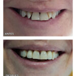 8.1-coronas-zirconio