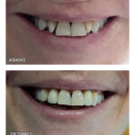 8.1-coronas-zirconio-ca