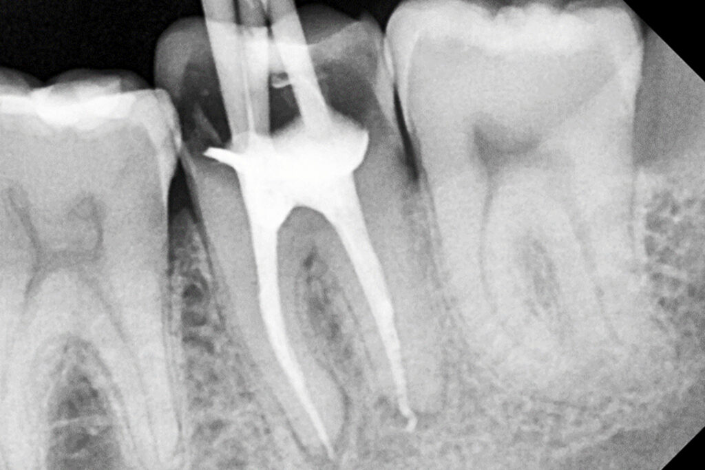 endodoncia | clinica dental mataro