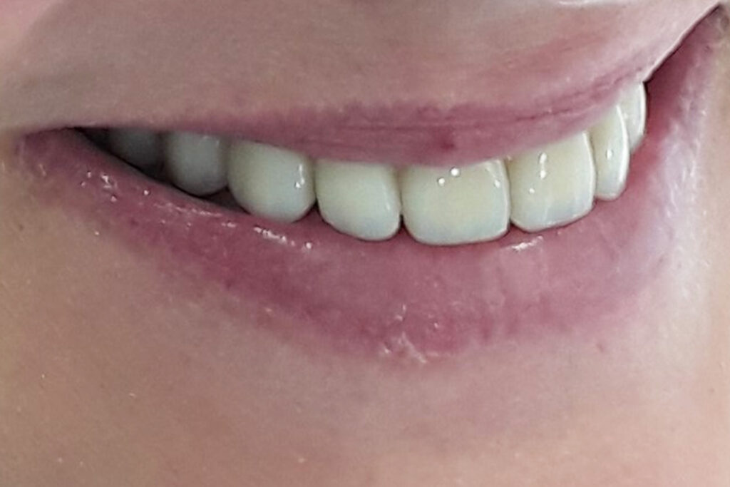 estetica dental | clinica dental mataro