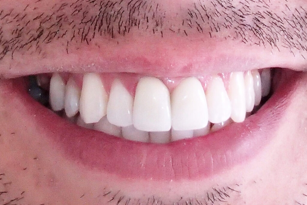 estetica dental | clinica dental mataro