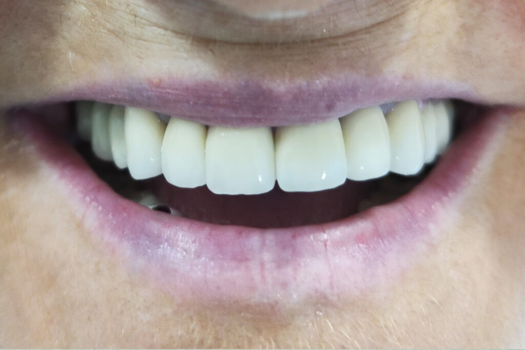 estetica dental | clinica dental mataro