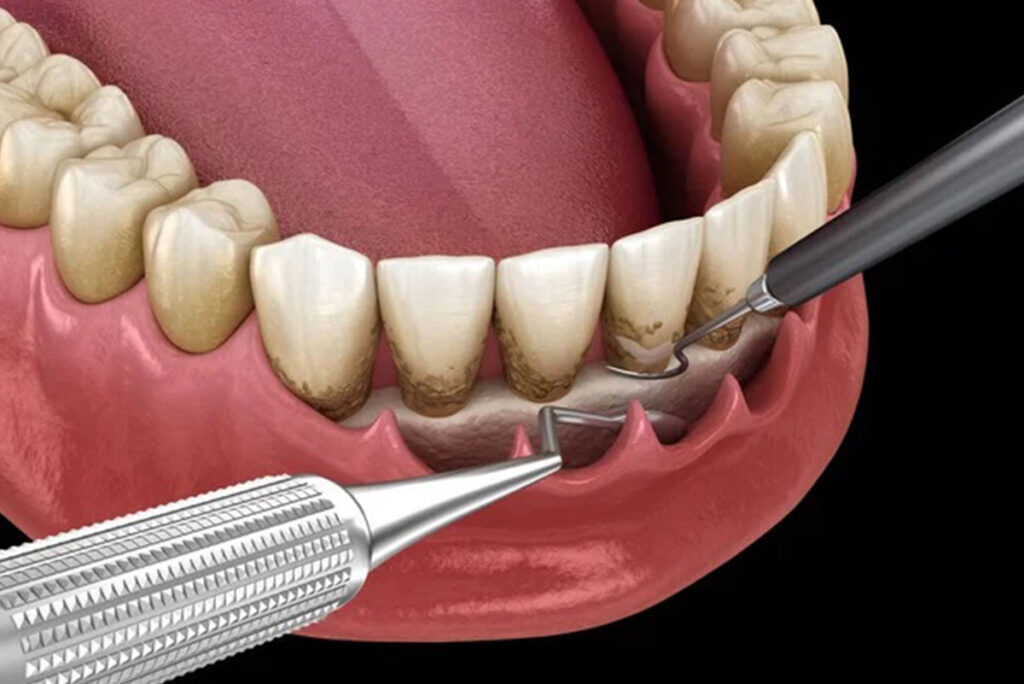 raspado y alisado radicular | clinica dental en Mataró