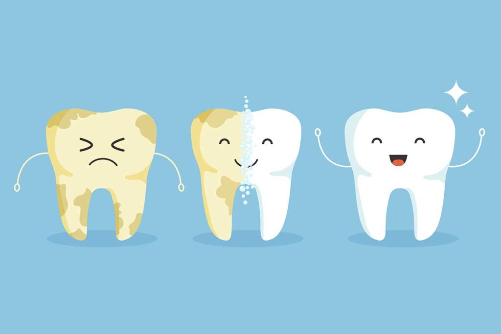 Biofilm Dental y como eliminarlo | Clinica Dental Vilaret en Mataró