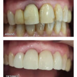 17-carilla-ceramica-ca