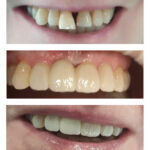 20-corones-de-ceramica-sense-metall