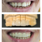 21-carilles-de-ceramica-ca